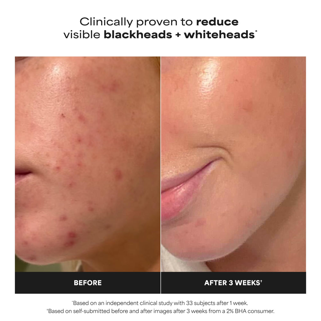 Paula's Choice SKIN PERFECTING 2% BHA Esfoliante Liquido