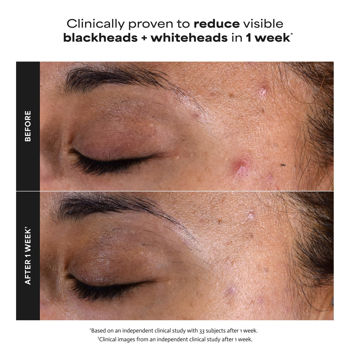 Paula's Choice SKIN PERFECTING 2% BHA Esfoliante Liquido